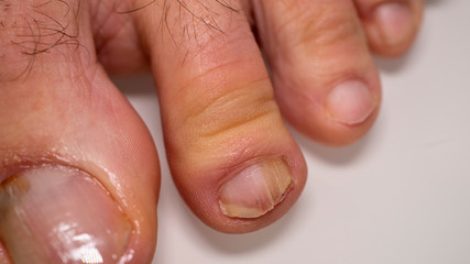 Nail infections caused by fungi such as: onychomycosis caused by dermatophytes and yeasts and for the concomitant antibacterial activity