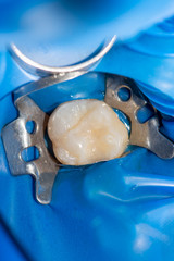 close-up treatment of a human tooth using a blue rabberdam system and a dental mirror. Aesthetic dentistry, hygiene
