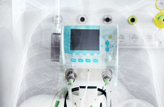 Double Exposure Of X-ray Image Of Lung With Pneumonia And ICU Medical Ventilator