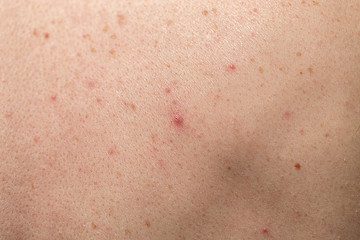Close-up of large rashes or smallpox on the skin of an adult male. Pigmented spots on the back of a man. Skin of a man with moles. Acne.