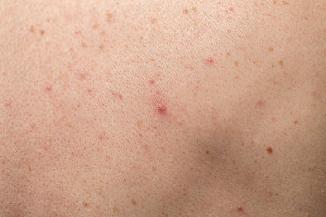 Fototapeta premium Close-up of large rashes or smallpox on the skin of an adult male. Pigmented spots on the back of a man. Skin of a man with moles. Acne.