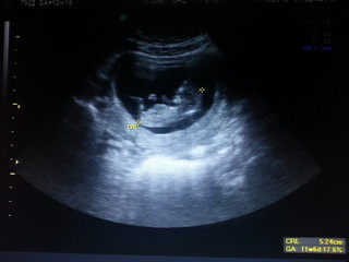 baby ultrasound