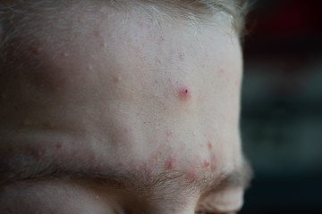 Fototapeta premium teenage boy with acné spots on forehead close up.
