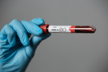 blood tests for the virus coronavirus covid 19