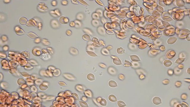 blood under a microscope, the movement of red blood cells is visible, some took the form of a drop, others became echinocytes, on which protrusions (spicules) and several macrophages appeared