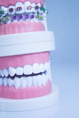 Model denture with metal orthodontics