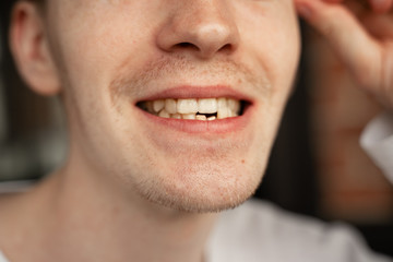 guy smiles without lower teeth, dental treatment, crooked teeth orthodontics