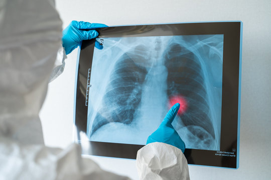 Scientist, Microbiologist or Dotor checking examining viral infection or pneumonia lesion on Chest X-ray film in laboratory