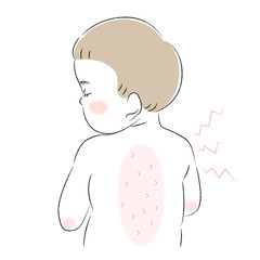 背中　肌　悩み　痒み　子ども　幼児