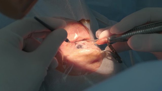 Cataract surgery close up. Surgeon operating eye cataract in hospital surgery