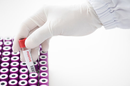 Doctor hand holding blood test tube  for laboratory analysis.Laboratory testing patient’s blood samples.Conceptual image coronavirus test tube sample that has tested positive for coronavirus.