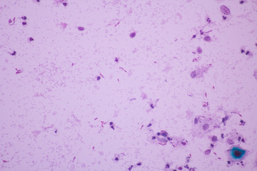 View in microscopic of Candidiasis, fungus infection (Yeast and Pseudohyphae form) in pap smear slide cytology and diagnostic by pathologist.Gynecology report and diagnosis.Medical concept.