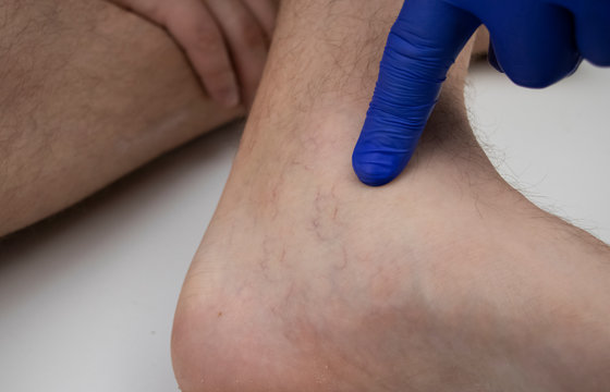 A man in consultation with a vascular surgeon. A doctor examines a leg with swollen veins. Varicose veins on the leg