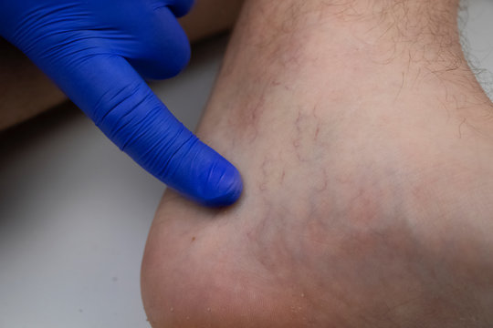 A man in consultation with a vascular surgeon. A doctor examines a leg with swollen veins. Varicose veins on the leg