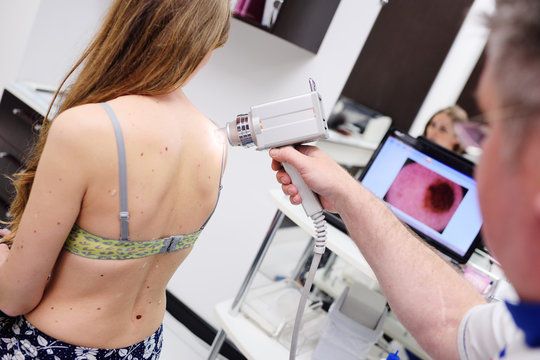 The doctor examines neoplasms or moles on the patient's skin - a young girl using a special apparatus for dermatoscopy - a dermoscope. Prevention of melanoma and skin cancer.