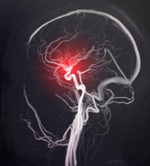 MRI image of a brain vessel. The concept of cerebrovascular disease, stroke and circulatory...