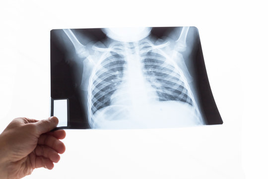 X-ray picture of the chest of a child.
