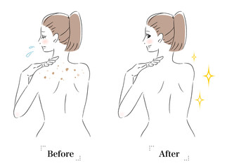 背中　肌　悩み　シミ　ビフォーアフター　女性