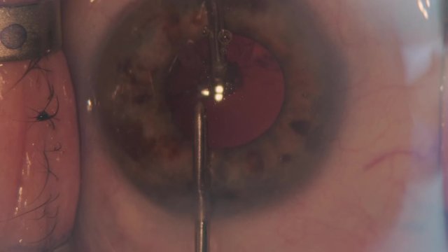 Macro footage of Eyes During Eye Surgery. Ophthalmological surgery.