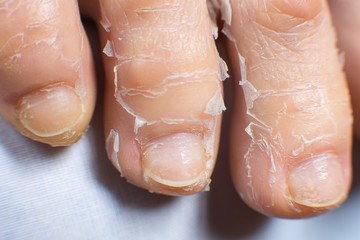 three female toes with exfoliating skin, close-up. peeling procedure.