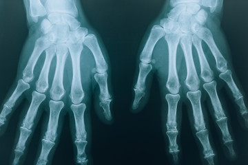 Skeleton: X-ray of two hands. Beautiful medical concept with a clear x-ray of two hands with fingers.