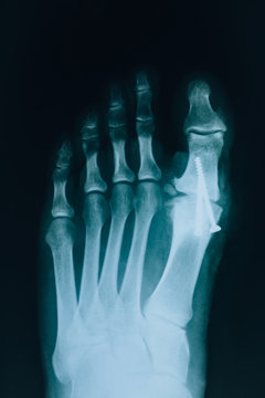 X-ray of the foot. Human foot, bones, at an appointment with a doctor orthopedist