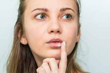 Herpes on the lips. Woman's face with finger on lips with herpes, beauty concept