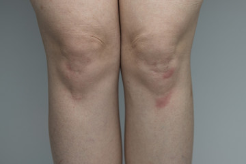 Close up of a woman standing facing the camera against a gray background, exposing the front of her knees with pale skin, freckles, redness, and bruising 