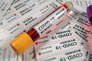 Covid-19 infectious disease, coronavirus a global threat
sars-cov 2 pasitive blood test
