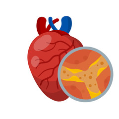 Cholesterol in vein and arteries. Heart and organ disease. Blockage and obstruction of canal. Magnified view under microscope. Health problem. Flat medical education