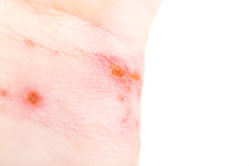 chemical burn on the wrist skin with hydroxide sodium acid, by striping paint from wood furniture....