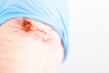 chemical burn on the wrist skin with hydroxide sodium acid, by striping paint from wood furniture. Household accident, because of blue gloves to sharp