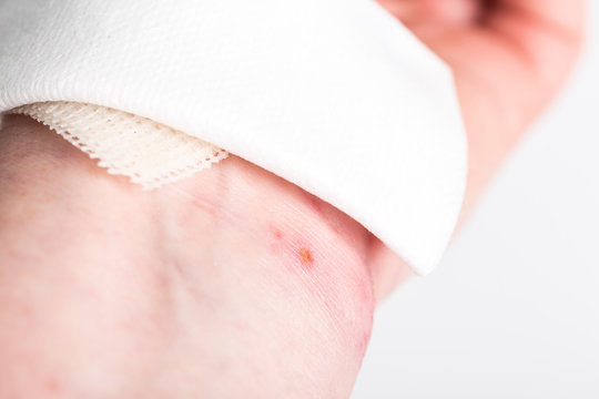 chemical burn on the wrist skin with hydroxide sodium acid. Household accident, because of gloves to sharp