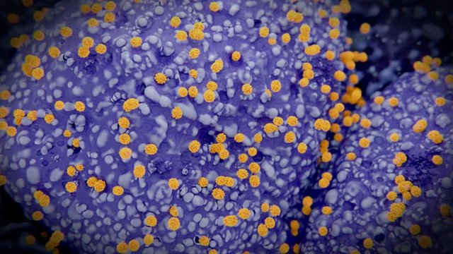 Coronavirus budding out of infected pneumocytes type II in a human lung. After the infection of human cells, coronaviruses multiplicate in the cells and bud out afterwards to infect other cells.
