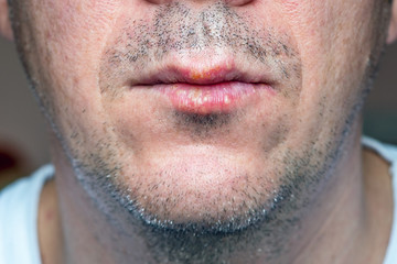 Fototapeta premium Herpes virus infection in a man on the lips