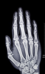 X-ray fluoroscopy of human fingers