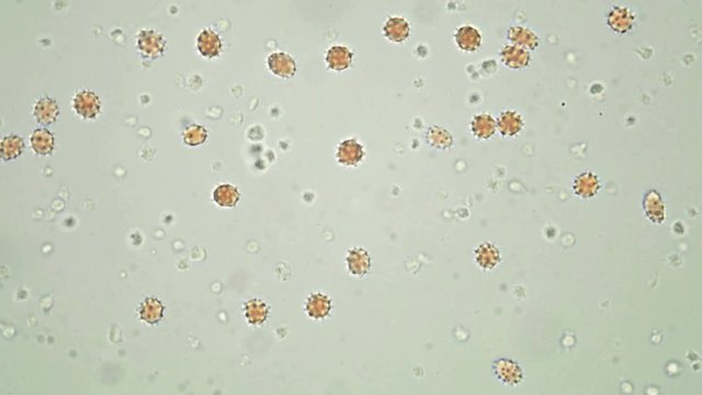 blood under a microscope, on the video leukocytes, red blood cells (echinocytes) and a lot of platelets: simple (aggregating) and overactive (procoagulant). This happens when the vessels are damaged
