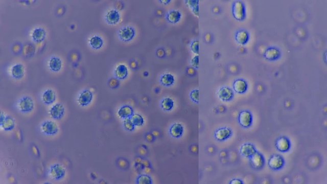 The model of the virus&rsquo;s reproduction in the body under a microscope, in fact, these are echinocytes in the blood that changed shape and they appeared spikes (spicules) like some viruses