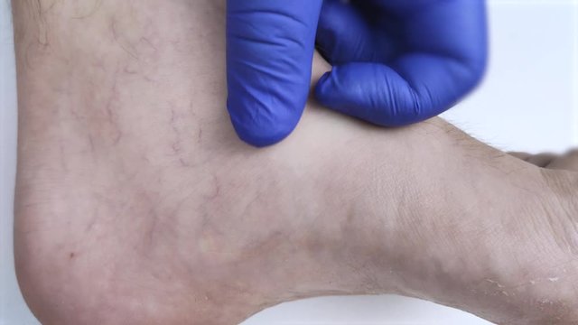A man in consultation with a vascular surgeon. A doctor examines a leg with swollen veins. Varicose veins on the leg