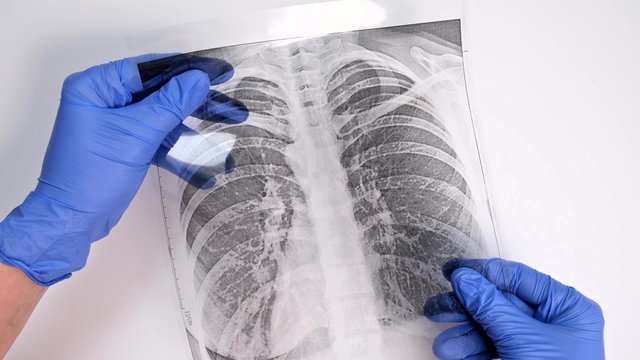 Hands of a doctor in blue gloves examining, checking fluorography, x-ray of a patient during epidemia, pneumonia and bronchitis treatment and diagnostic