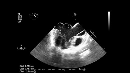 Image of the heart in gray-scale mode during transesophageal ultrasound.