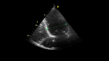 Image of the heart in gray-scale mode during transesophageal ultrasound.
