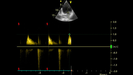 Image of the heart in gray-scale mode during transesophageal ultrasound.