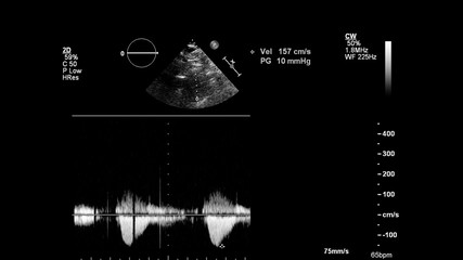 Image of the heart in gray-scale mode during transesophageal ultrasound.