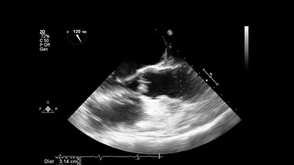 Image of the heart in gray-scale mode during transesophageal ultrasound.
