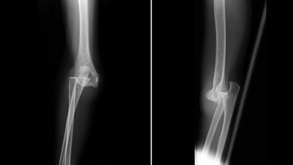 Film X ray elbow radiograph show elbow dislocation. Joint dislocation injury from physical assault....