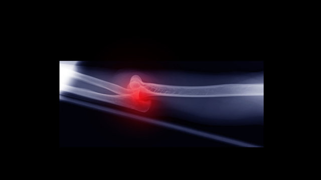 Film X-ray elbow radiograph show elbow dislocation. The patient has joint dislocation from sport injury. Highlight on luxation site and painful area. Medical imaging and diagnosis technology concept