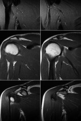 MRI scan of the shoulder joint