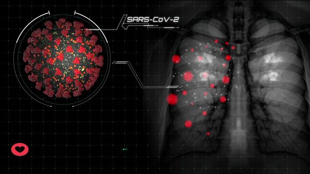 COVID-19, Coronavirus disease or tuberculosis infection on lung chest X-ray radiography imaging film displaying respiration illness of woman patient's health in medical diagnostic analysis