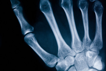 x-ray picture of the wrist of hand